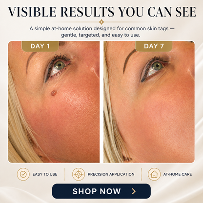 TAGLISSE™ Auto Skin Tag Remover Kit