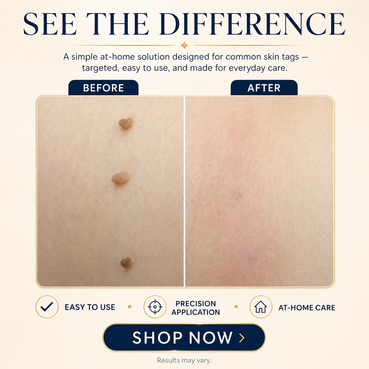 TAGLISSE™ Auto Skin Tag Remover Kit